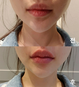 linnn's Lip Filler review