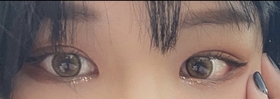 뼉효's Canthoplasty review