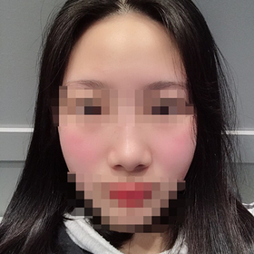 효콩2's Filler, Botox review