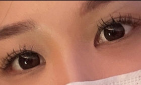 sidhd22's Lateral Canthoplasty, Lower Canthoplasty review