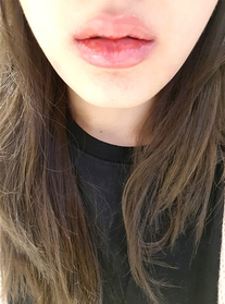 지똘이's Lip Filler, Botox review