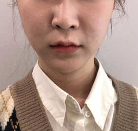 kkkkyu님의 울쎄라 후기