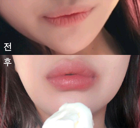 bkbkbk's Lip Filler review