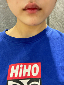 지윤스's Square Jaw Botox review