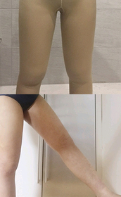 꺅긱꺅's Liposuction review