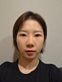 치얼쓰쓰's Mini Facelift review