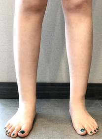 꿀타빈's Calves, Abdominal Liposuction review