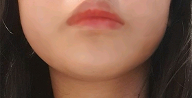 긔단님의 레이저리프팅 후기