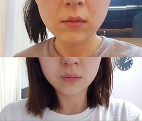 deinmm's Shurink, Contouring Botox review