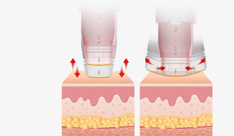 Presisi dengan Hidden Edge Tip - gambar detail
