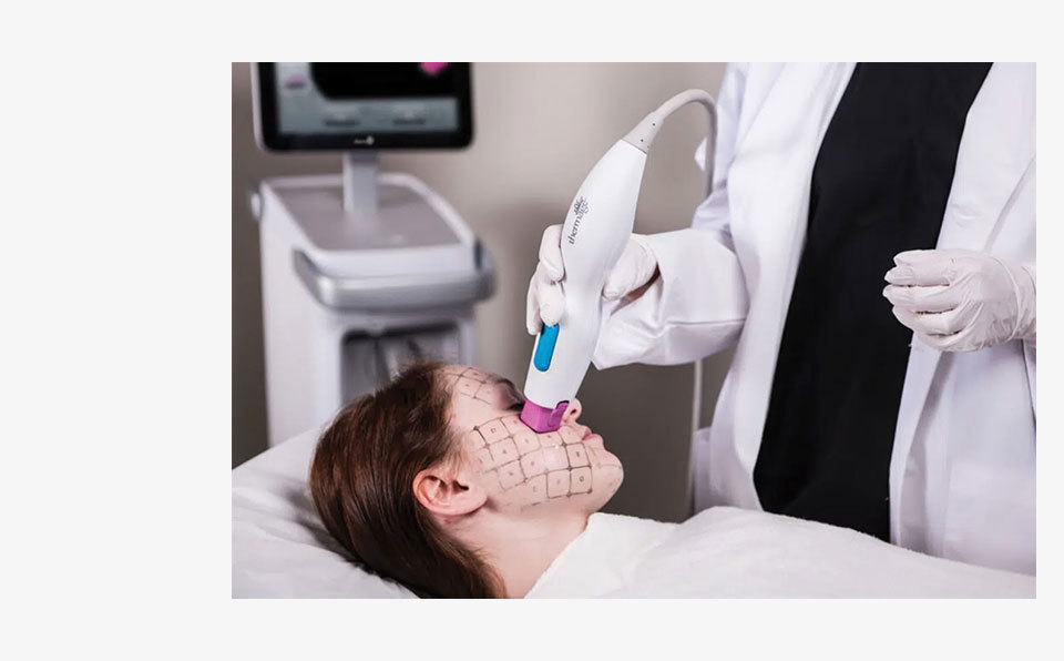 Thermage FLX U.S. FDA-Approved Global Standard Lifting Device