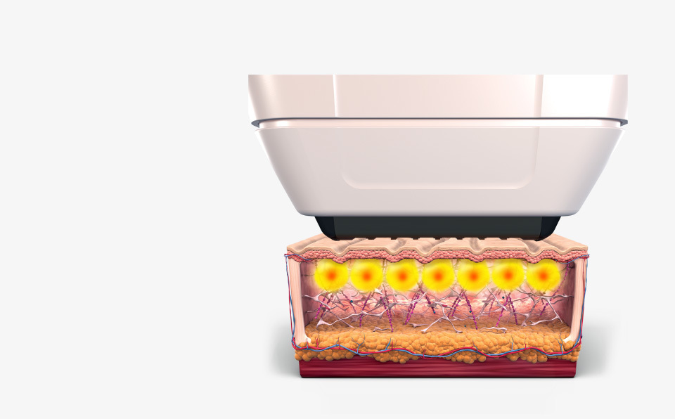Sofwave safe procedure epidermal protection and temperature control