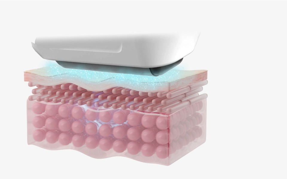 Sofwave precision ultrasound technology