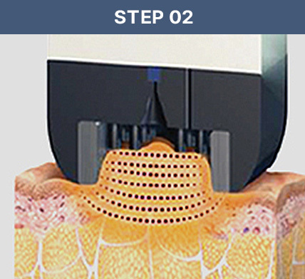 Inmode STEP 02