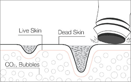 EXFOLIATION — Eksfoliasi - gambar detail