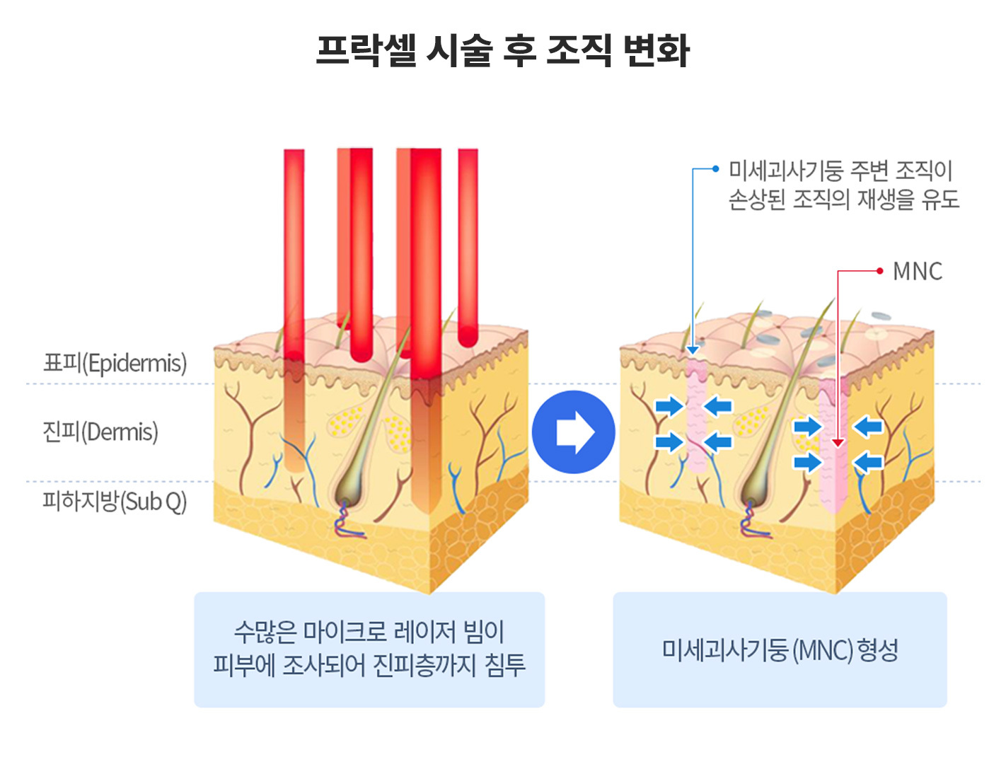 Fraxel | Nana Dermatology - feature image