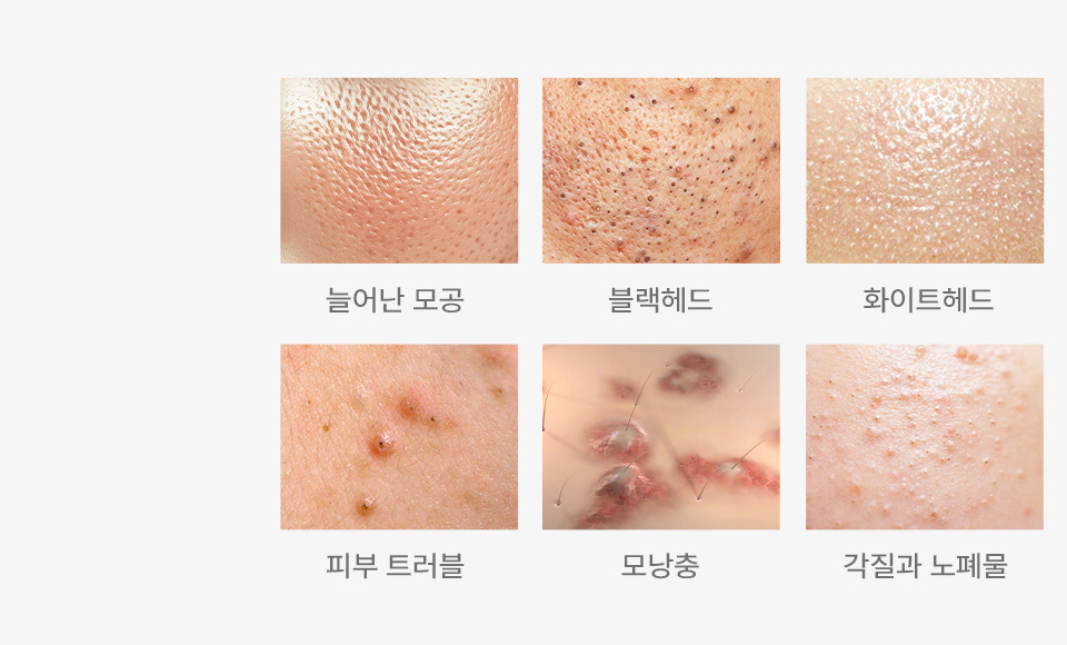 Atasi Masalah Kulit dengan 3 Tahap Aqua Peel - gambar detail