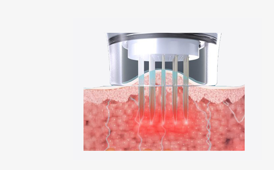 Effective penetration of skin booster ingredients - detail image