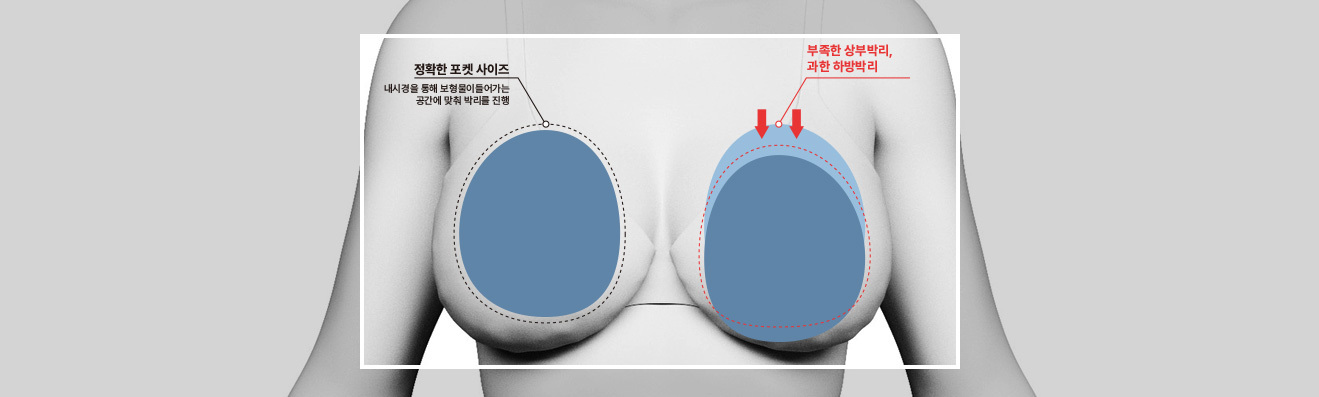 About bottoming-out surgery - procedure image