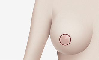 CASE.2 Sayatan Areola (Untuk Payudara dengan Tingkat Kekenduran Ringan) - gambar detail