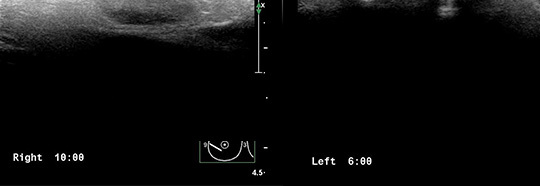 Checked with high-resolution ultrasound
