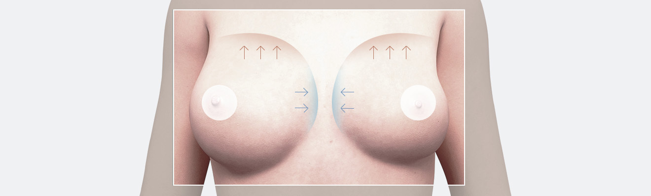 Why choose a plastic surgery clinic with a dedicated breast clinic? - procedure image