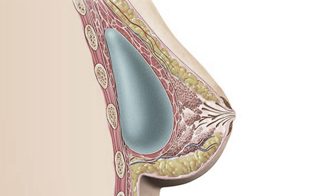 Subfasial - gambar detail