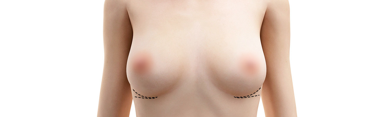 About implant removal surgery - procedure image