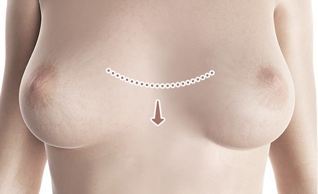Dada menonjol (pigeon chest) dengan arah puting menghadap ke luar. - gambar detail