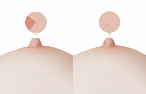 Pengecilan Puting (Jika Lebar Puting Terlalu Besar) - gambar detail