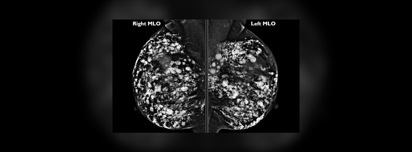 Diagnosis yang Dapat Diketahui melalui USG Payudara - gambar prosedur