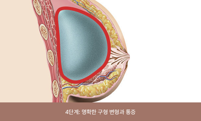 The breast appears distinctly spherical in appearance and is accompanied by pain