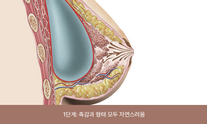 The implant cannot be felt and it is difficult to perceive its presence