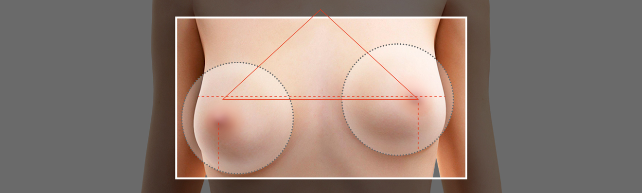 Acquired breast asymmetry - procedure image