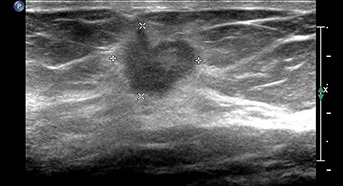 Breast disease screening and treatment