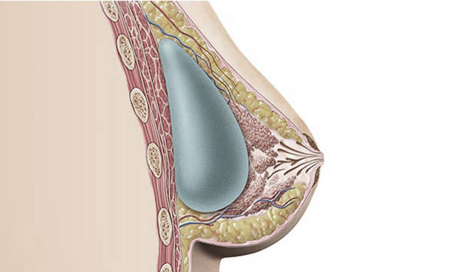 Subglandular - gambar detail