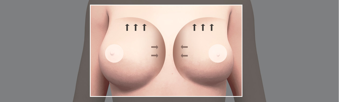 Dissatisfaction with size - procedure image