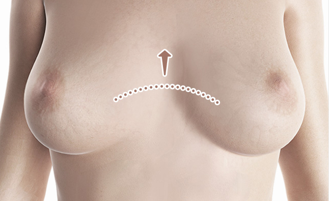 Dada cekung (funnel chest) dengan arah puting menghadap ke dalam. - gambar detail