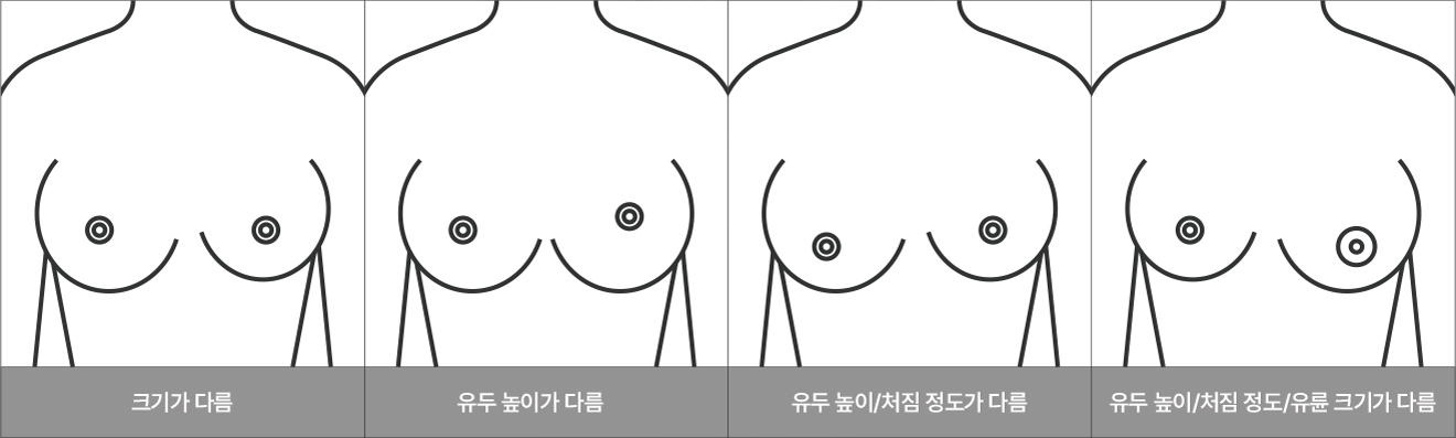 Congenital breast asymmetry - procedure image