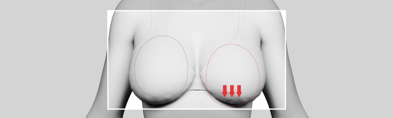 About bottoming-out surgery - procedure image