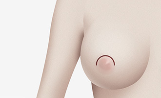 CASE.1 Sayatan Bulan Sabit (Untuk Payudara dengan Tingkat Kekenduran Ringan) - gambar detail