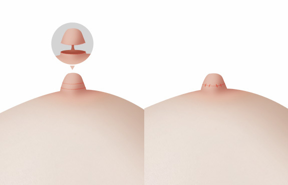 Pengecilan Puting (Jika Panjang Puting Terlalu Berlebihan) - gambar detail