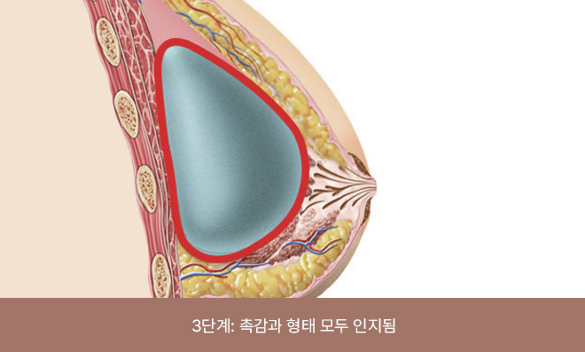 The implant feels firm and the breast shape shows deformation