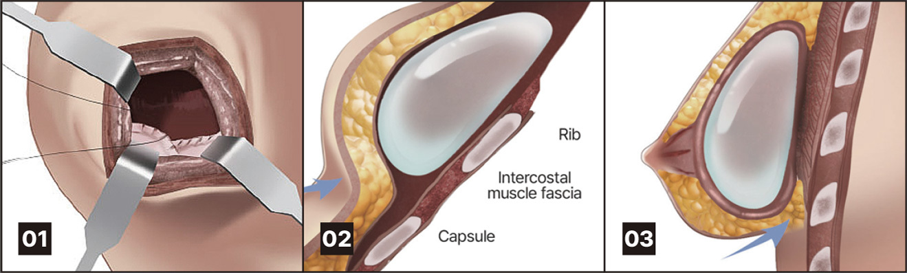 Bottoming-out surgical methods - procedure image