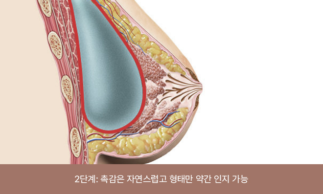 The implant feels soft and its position or boundaries may be partially felt