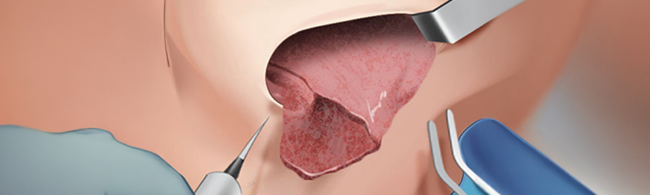 Capsular Contracture Surgery Method - procedure image