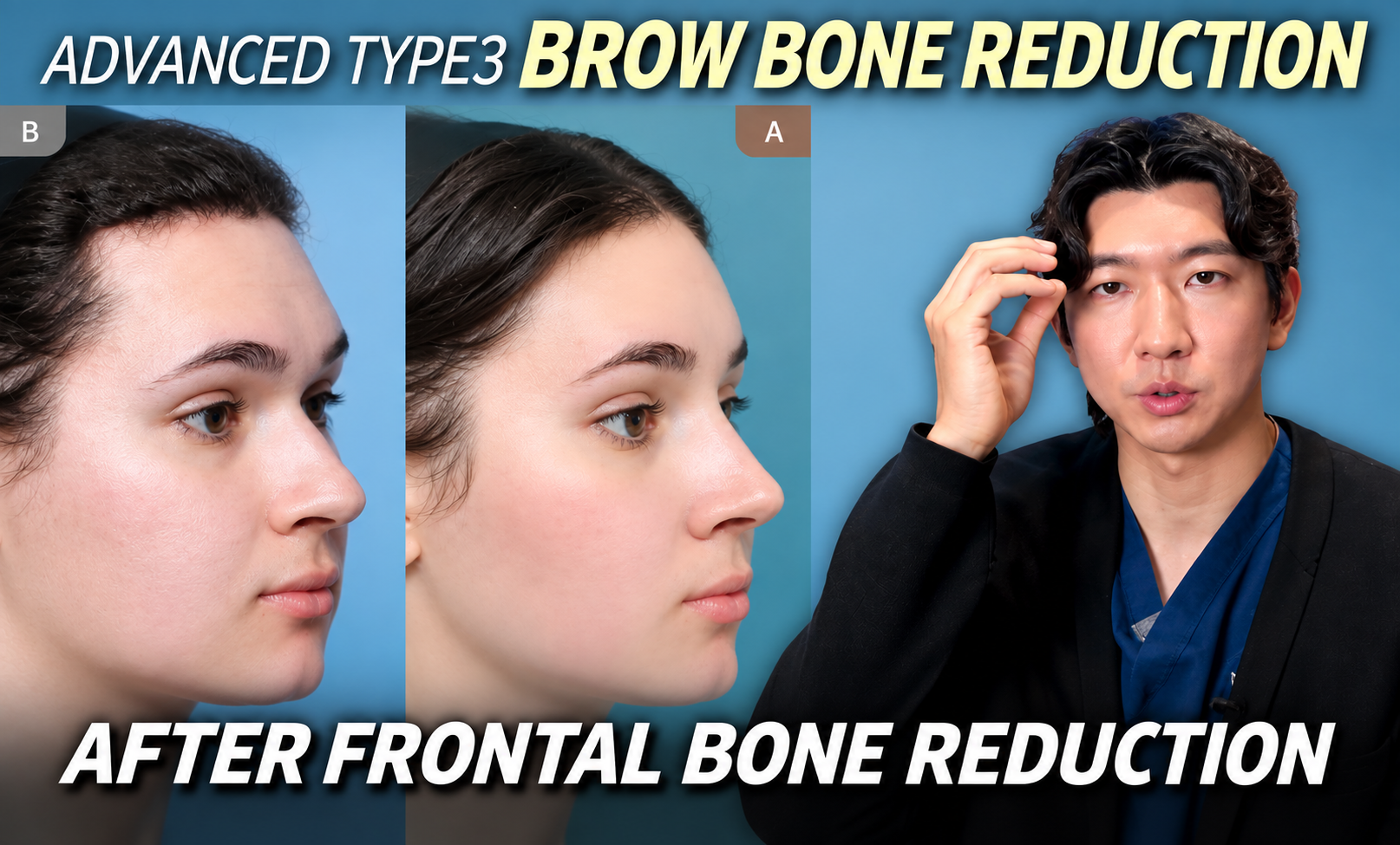 Why Brow Bone Reduction Is Essential in Facial Feminization Surgery?