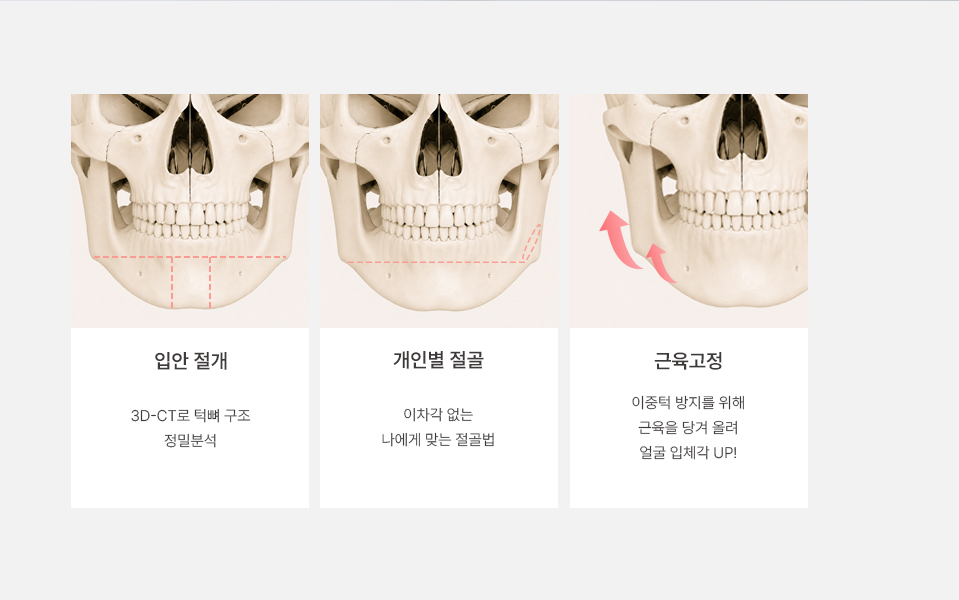 나나성형외과 광대 재수술 설명 문구, 개인 얼굴 구조에 맞춘 광대 재수술 방법 안내