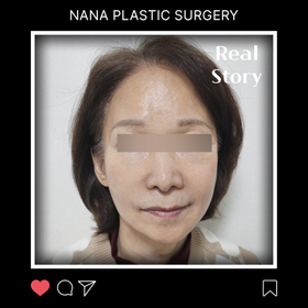 나의행복님의 안면거상 후기