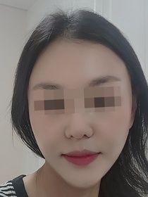 경시리님의 안면거상 후기
